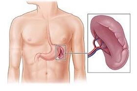 liesas patoloģija kā sāpju cēlonis zem kreisās lāpstiņas