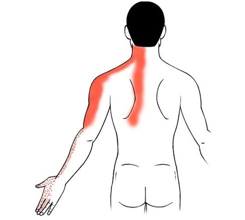 dzemdes kakla osteohondroze kā sāpju cēlonis pirkstu locītavās