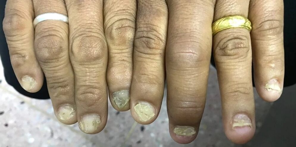 Pirkstu pietūkums un nagu plāksnes deformācija var liecināt par psoriātiskā artrīta attīstību